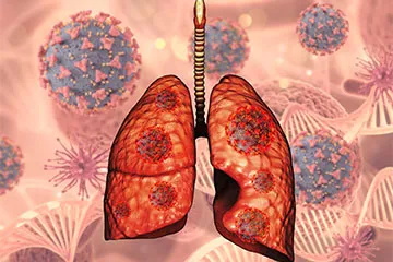 Lung Cancer Surgery in Vastral